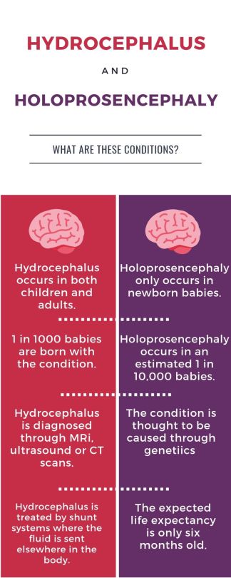 hydrocephalus